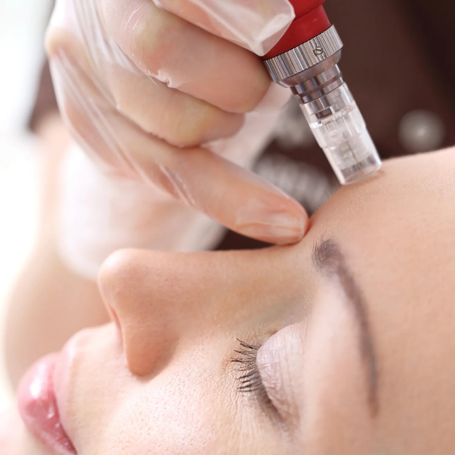✨ Treatment Spotlight: Microneedling for Smooth, Glowing Skin