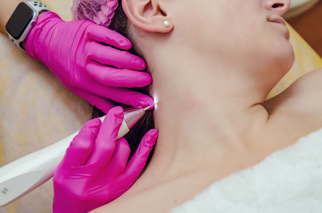 Eliminación de Fibromas (Skin Tags)