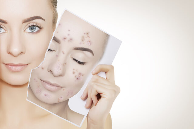 Facial para el Acné